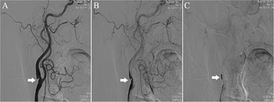 The Value of Contrast-Enhanced Ultrasound in the Evaluation of Carotid Web